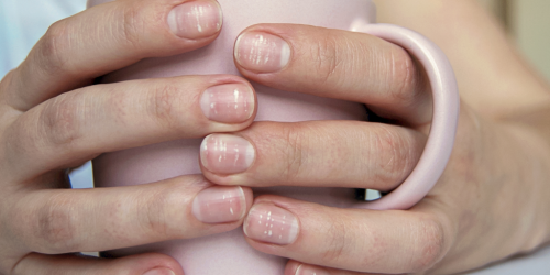 hands around coffee mug, white spots on nails
